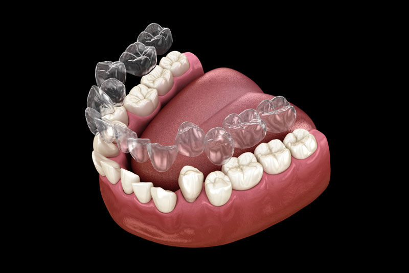 Clear Correct Aligners Graphic