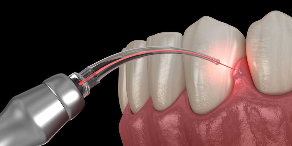 LANAP Gum Disease Laser Treatment Graphic