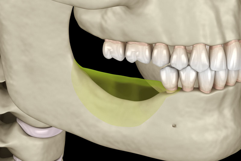 Jaw With Bone Loss
