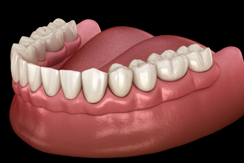 Dentures On Gumline