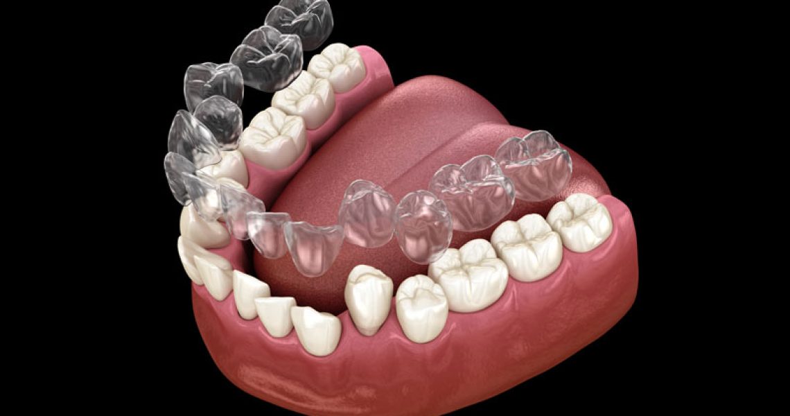 Clear Correct Aligners Graphic