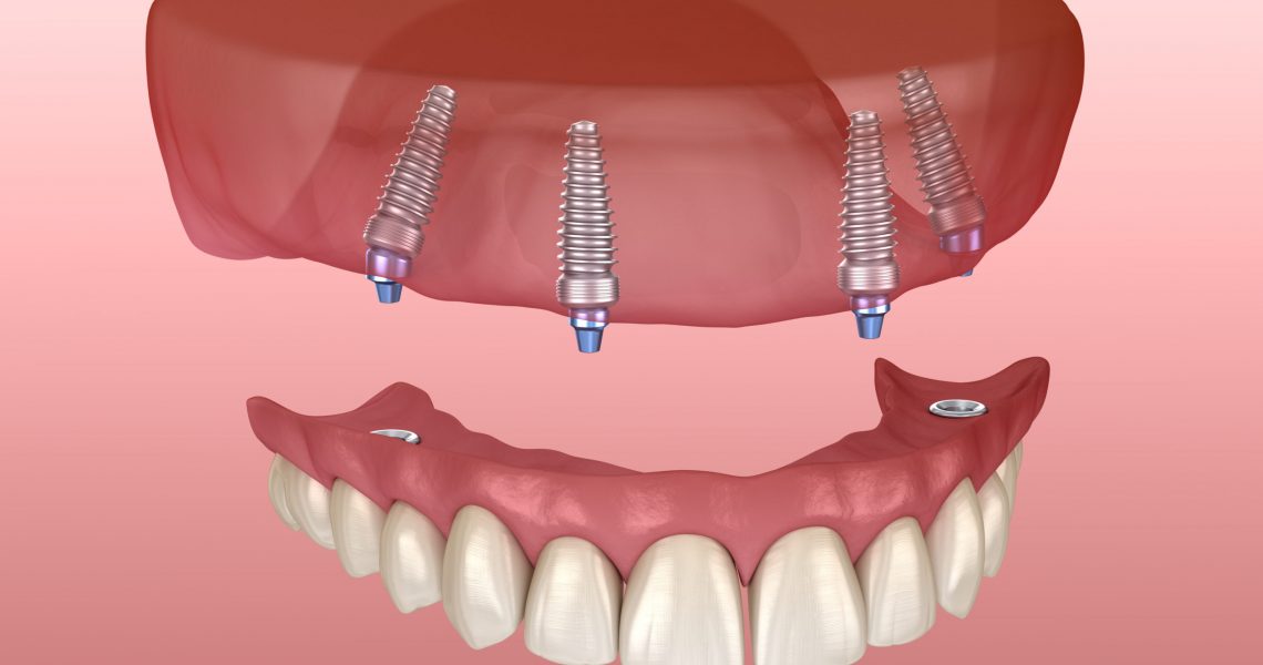 implant supported dentures in Phoenix, AZ
