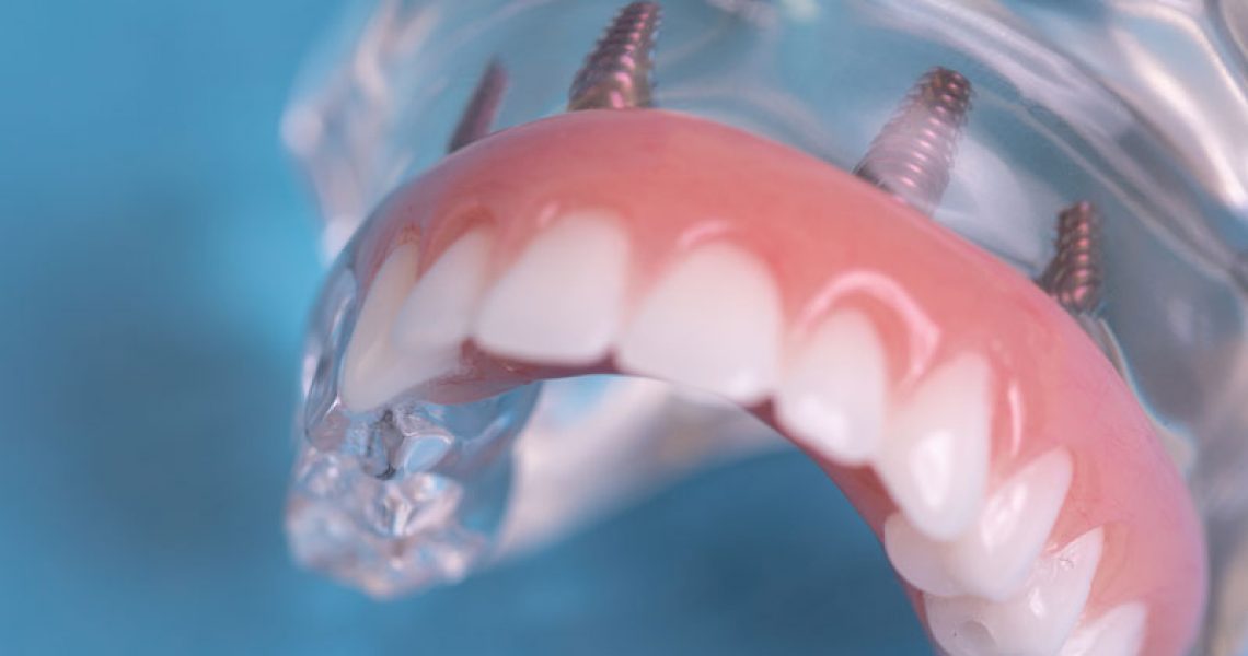 Full Arch Dental Implant Model